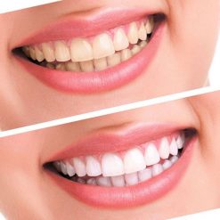 Kit Blanqueador dental con peróxido 10pcs - Imagen 5